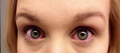 Zarudnutí očí je jedním z příznaků alergie