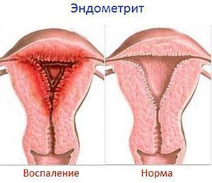 Diagnostika endometritidy