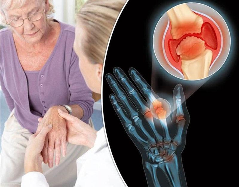léčba artritidy