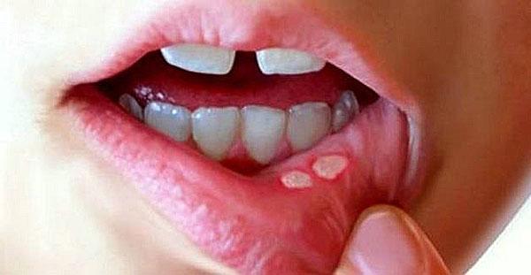 التهاب الفم