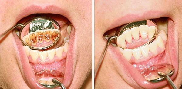 Zahnstein mit einem Sud aus Nussschalen entfernen